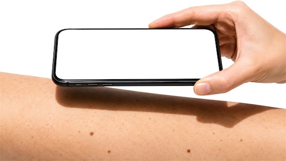 HLTH Europe: Skin Analytics brings clinical-grade skin cancer checks to smartphones